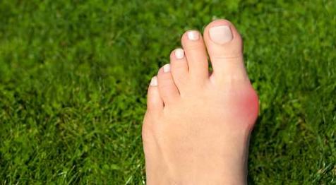 Barfußschuhe gegen Hallux Valgus: Die Lösung für gesunde Füße?